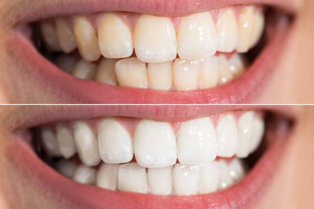 牙釉质可以自我修复