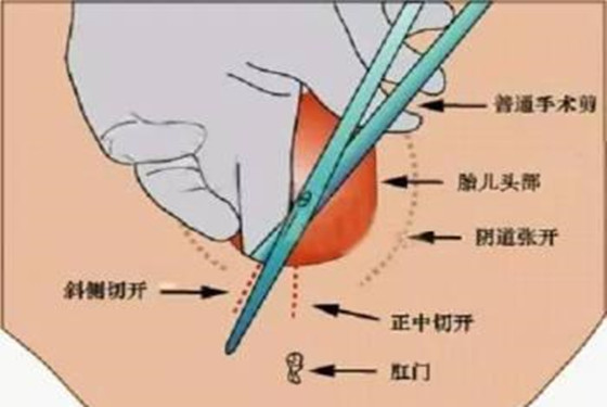 女人生小孩顺产缝针图 看得我心里直打颤
