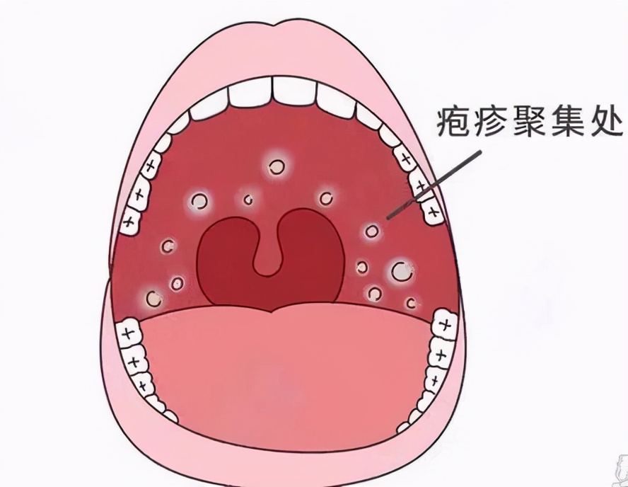 疱疹性咽峡炎高发期,孩子5岁前易中招!医生建议家长速看