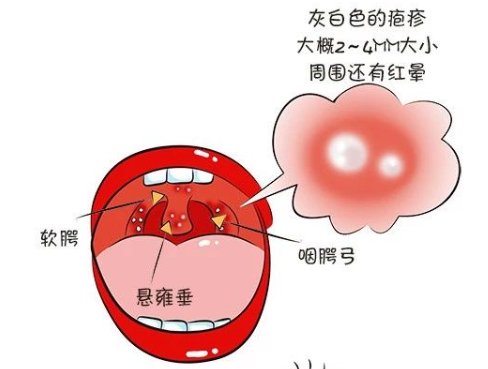 疱疹性咽峡炎高发季节6岁儿子中招了照护经验给你早预防