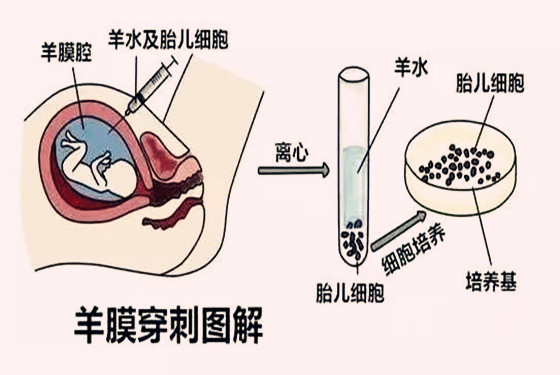 羊水穿刺示意图图片