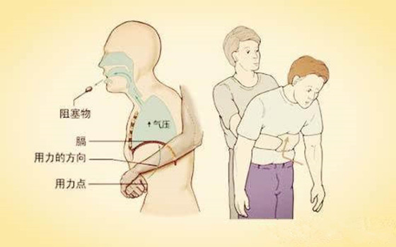 記住海姆立克急救法有哪些步驟 關鍵時刻能救命